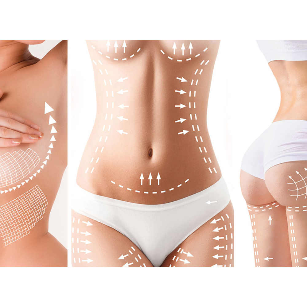 Zones de traitement du corps féminin illustrées pour chirurgie esthétique (ventre, seins, fesses)