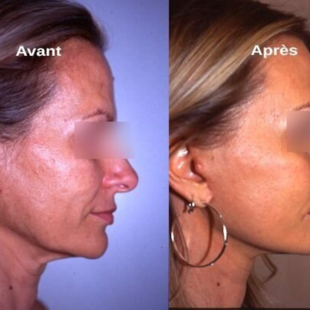 Résultat avant/après sur une joue traitée contre les taches pigmentaires