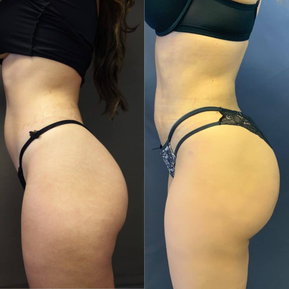 Avant et après augmentation des fesses par chirurgie esthétique