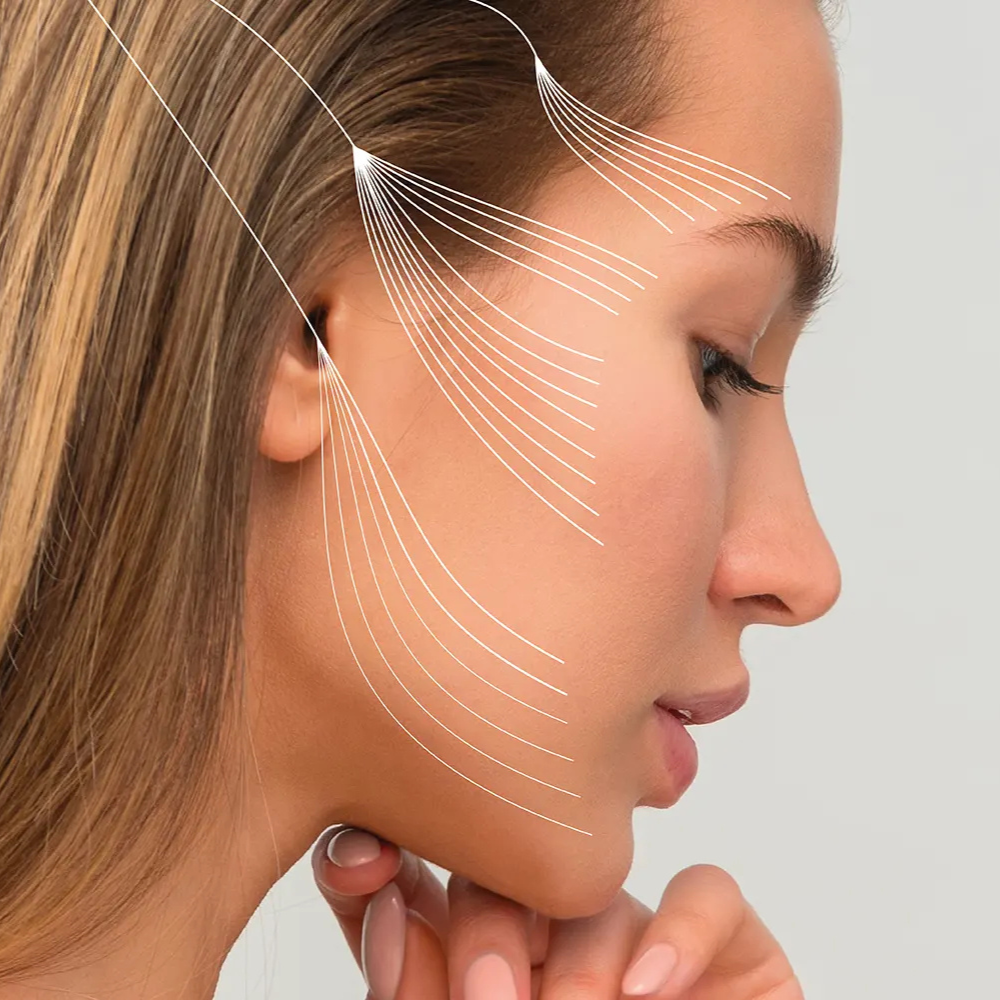 Illustration du lifting facial par fils tenseurs sur le visage d’une femme